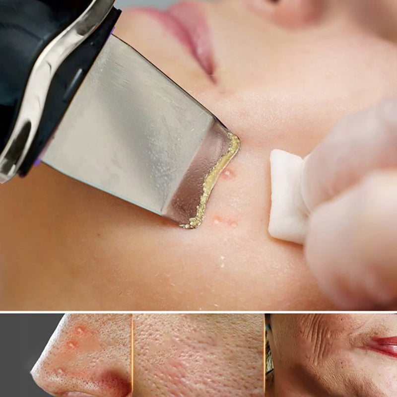 CAVITATION PEELING DEVICE FOR CAVITATION PEELING SMOOTH REJUVENATION Packaging status original
