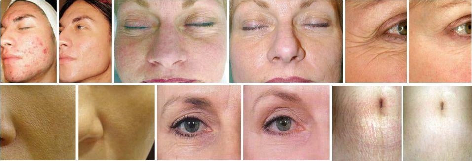 Derma Roller ZGTS 0,5mm Titanium Wrinkles Brand Moc Urody