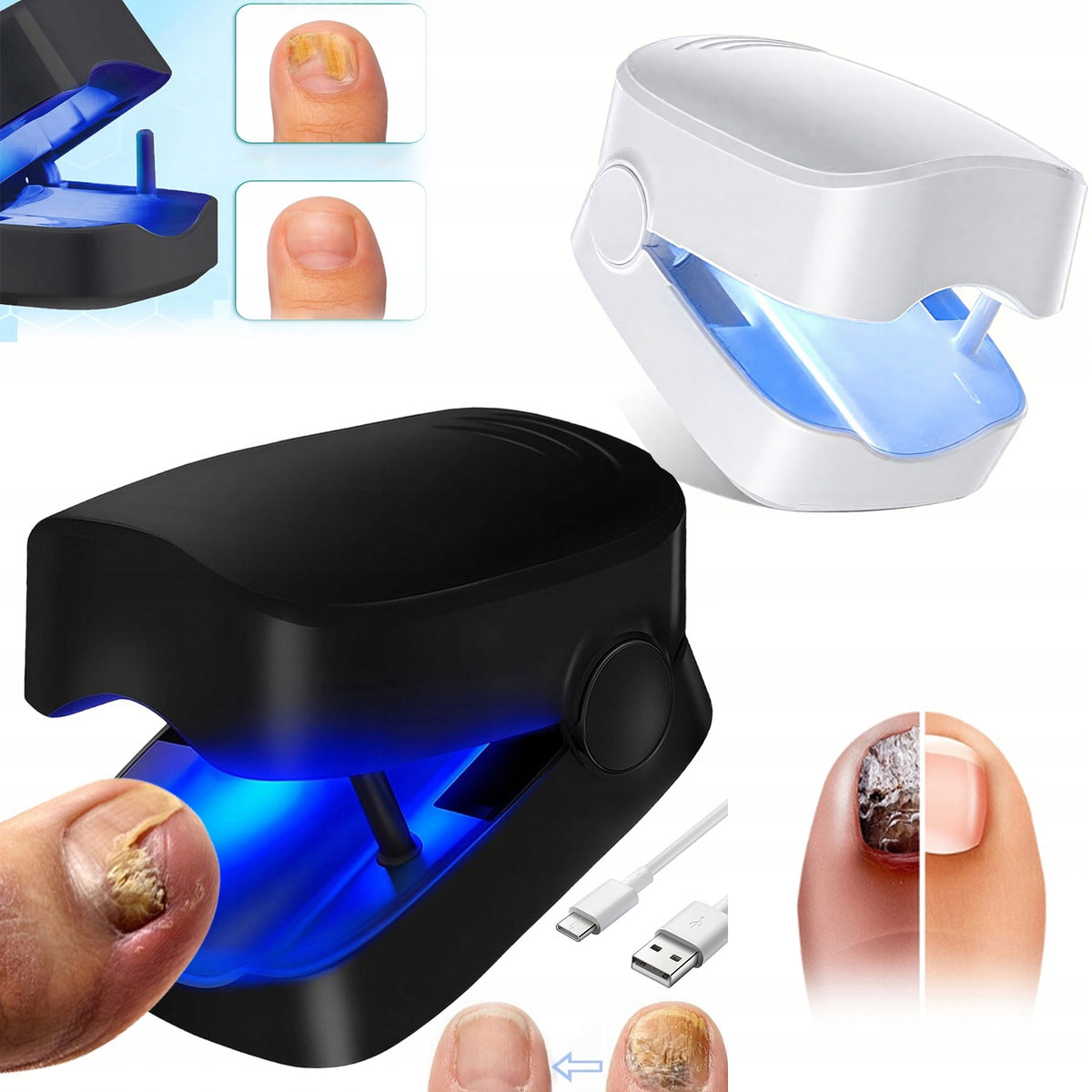 LASER FOR NAIL FUNGUS 407NM WITHOUT DRUGS HOME TREATMENT Model Lampa do paznokci