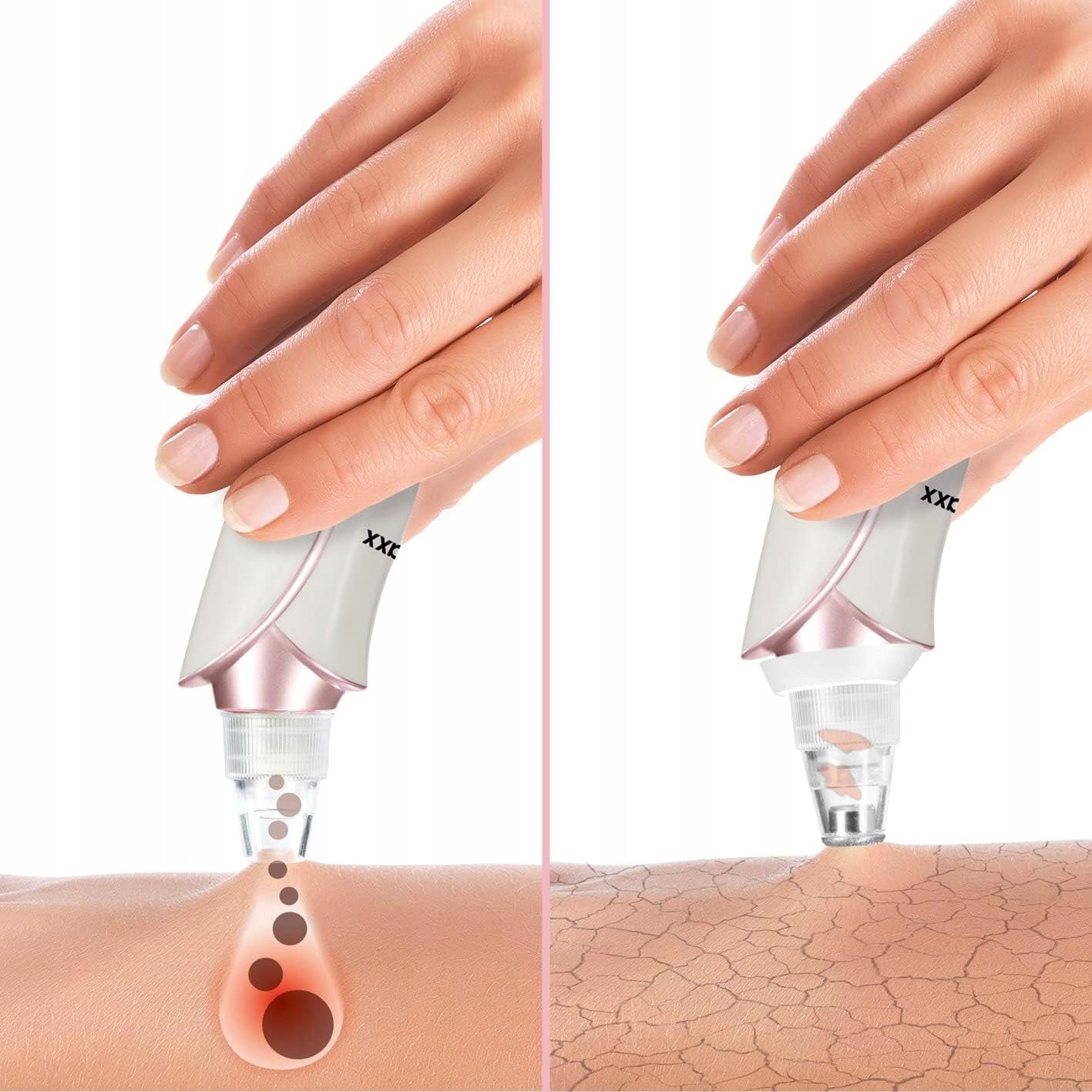 Professional device for cleansing the face from the pores of blackheads PRO AKU EAN (GTIN) 4067116276756