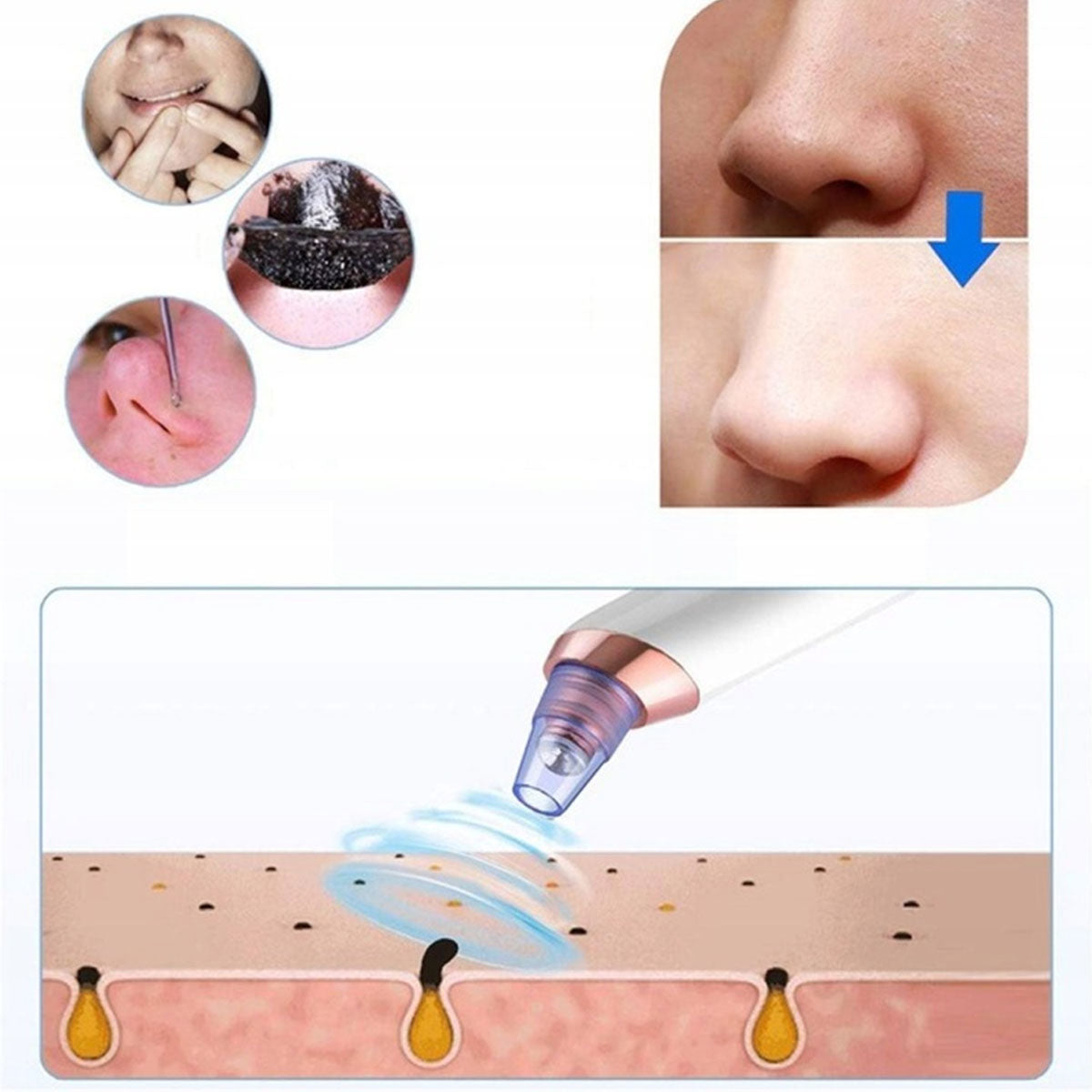 VACUUM CLEANER FOR BLACKHEAD USB FACIAL PORE CLEANSING DEVICE Medical device no