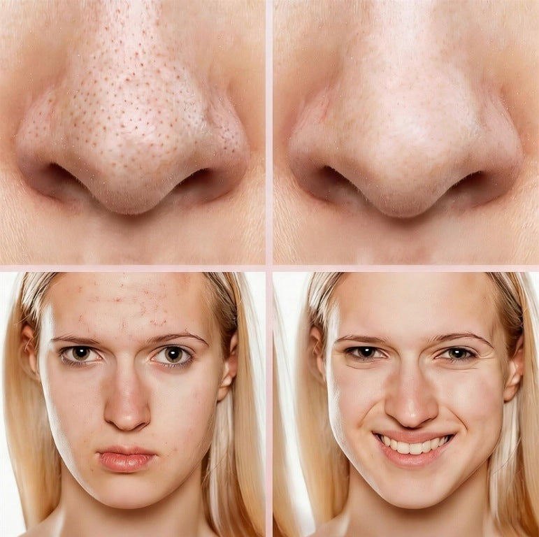 Blackhead vacuum cleaner blackheads and acne Brand no brand