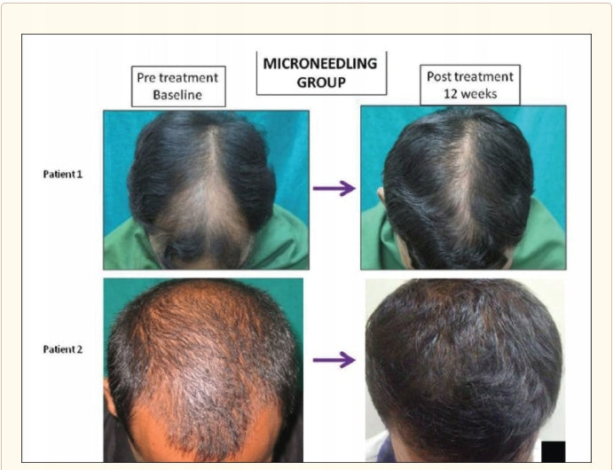 Derma ROLLER THICK BEARD Alopecia MESOTHERAPY Beard Facial Hair Manufacturer code Dermo Roll