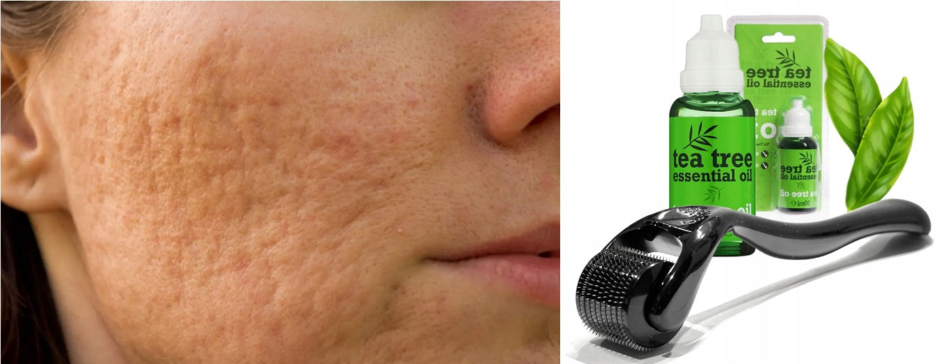 For acne scars deep scars discoloration Derma Roller + Oil Medical device no