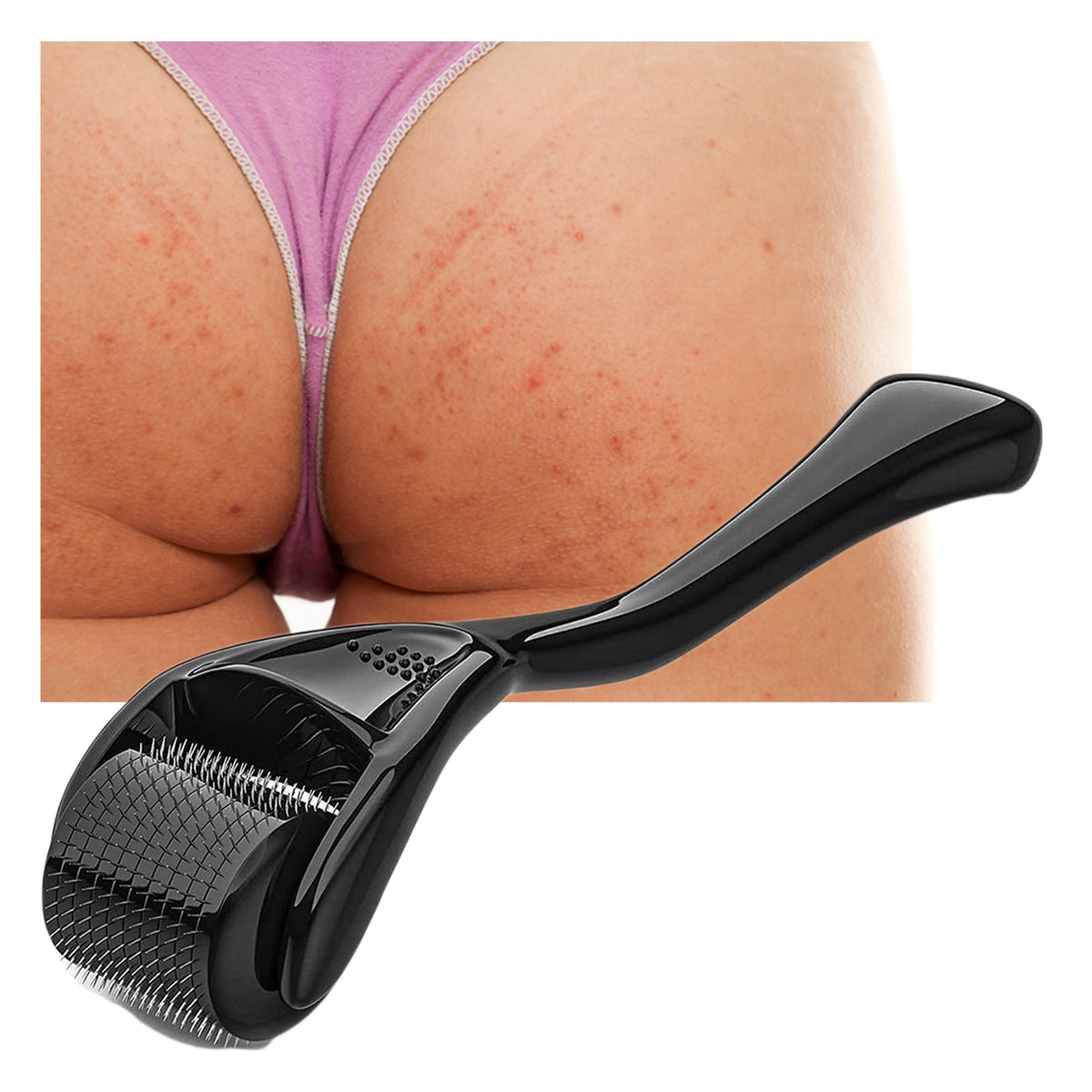 For pimples pustules on butt buttocks pustules Derma Roller LAROXY + Oil Medical device no