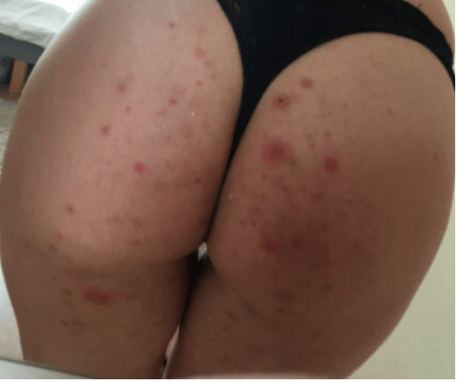 For pimples pustules on butt buttocks pustules Derma Roller LAROXY + Oil Packaging status original