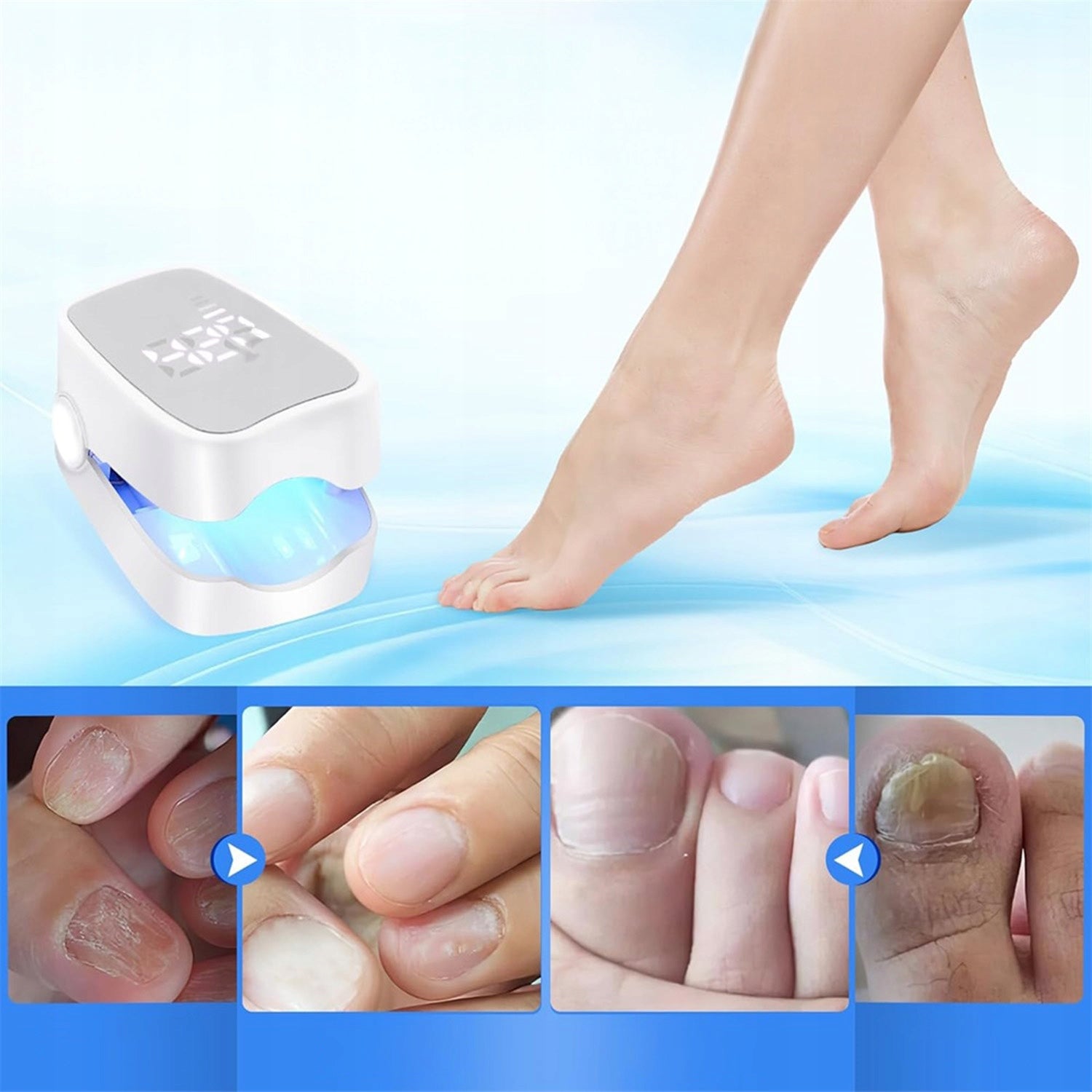 LASER NAIL FUNGUS TREATMENT DEVICE 910NM LIGHT Brand no brand