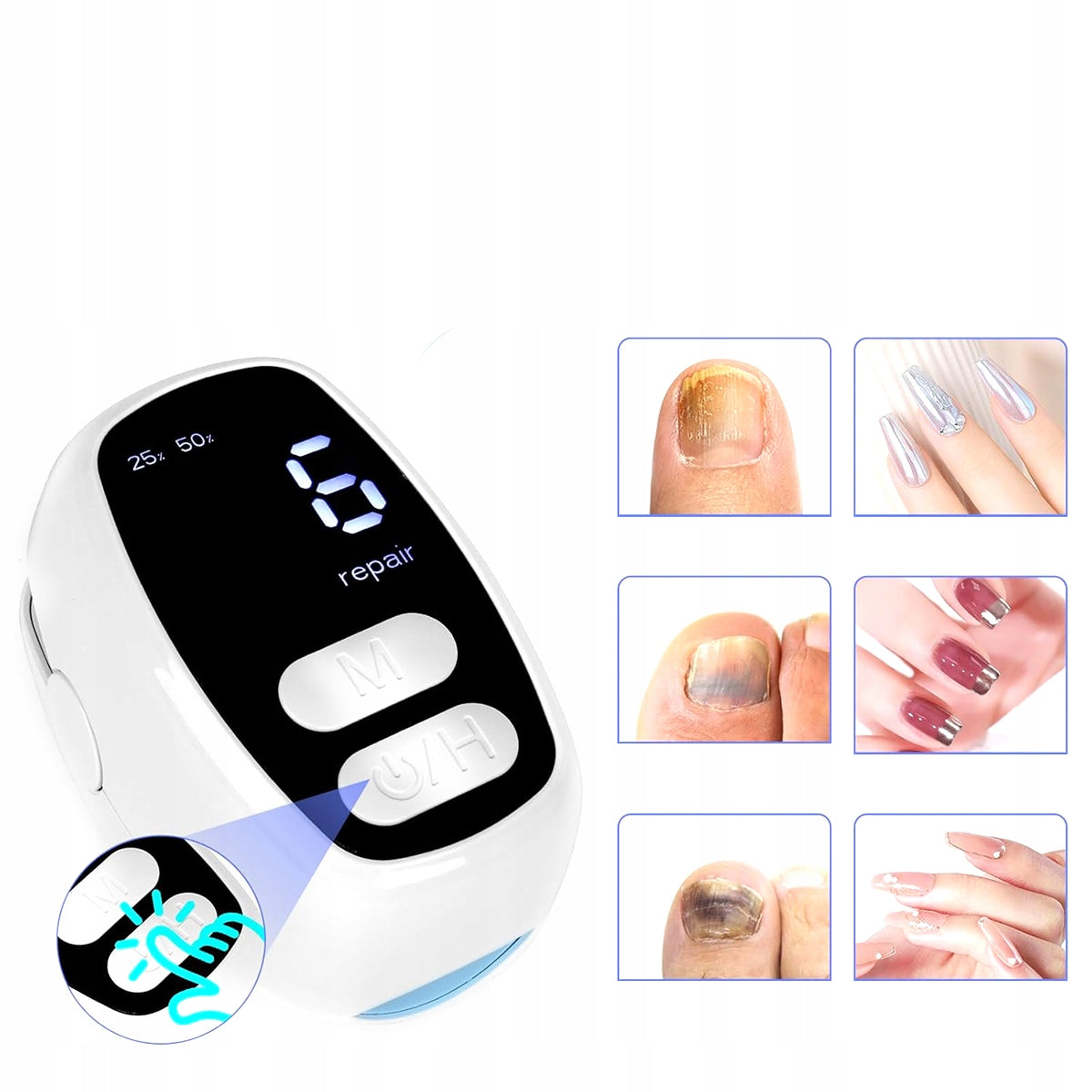 Laser device for the treatment of ringworm | Hands and Feet Packaging status original