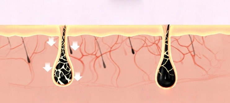Laser hair removal device, suitable for pain-free hair removal on the face, Packaging status original