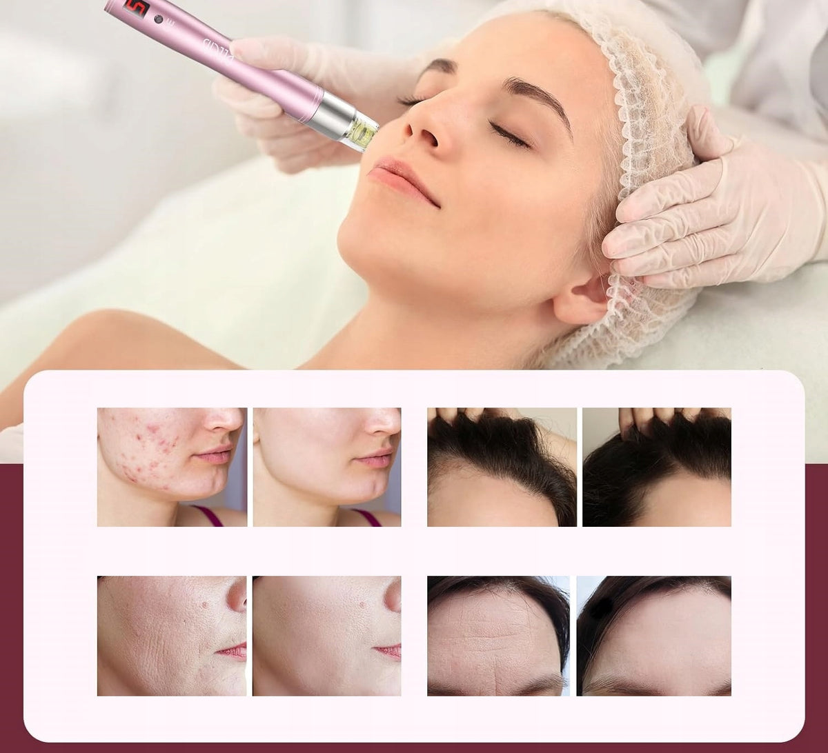 Professional dermapen for Mesotherapy PELCAS Beauty Pen A3 5 speed Manufacturer code 6915872487641